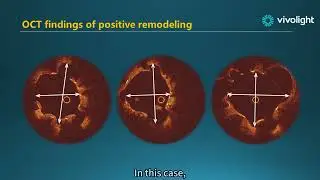 OCT Training course&mdash;&mdash;about the content of stent related measurements