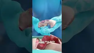 Living Without A Stomach 😮