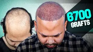 Case Study of Grade 7 Baldness 😊 | Hair Transplant in Bangladesh | New Roots