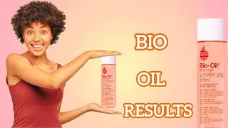 Bio-Oil Review: Real Results on Scars, Stretch Marks & Glowing Skin