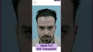 FUT Hair Transplant | FUT Hair Transplant results | #hairtransplantresults #youtubeshorts #shorts