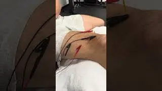 Dry Needling for Knee Pain (Quad Tendinopathy) #physicalrehabilitation