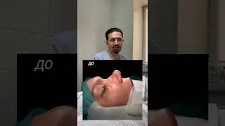Нестандартная, сложная ринопластика 👃