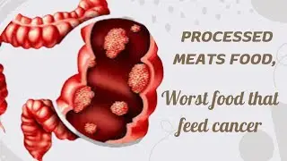Processed Meats, worst food that feed cancer