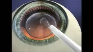 Visian ICL