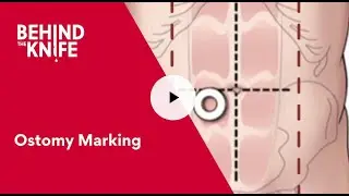 Behind the Knife - Ostomy Marking