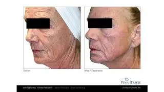 Venus Freeze - Before & After