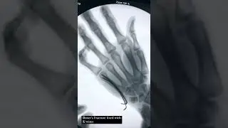 Boxer&rsquo;s Fracture Fixation with K-wires by AO Trauma Principles.