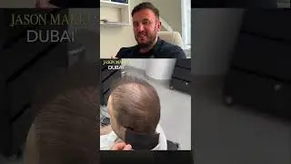НЕ ДЕЛАЙТЕ ПЕРЕСАДКУ ВОЛОС