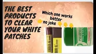 #whitepatches #skincare How To Clear Your White Patches Finally👌Using This Products, No Joke.