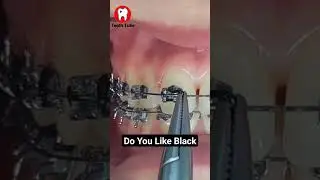 Do You Like Black Elastics #bracescolors #braces #shortvideo #shorts