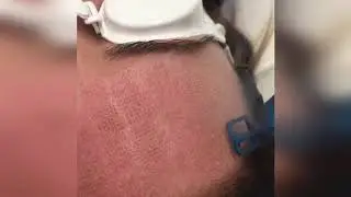 Лазерная шлифовка лица в CosmoDerm Laser Clinic