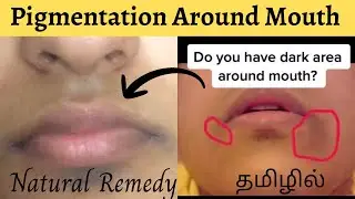 Home Remedies for darkness around mouth|pigmentation Remedy|DIY Cream,Mask|How To ReducePigmentation