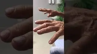 Tremor essencial/ Essential Tremor