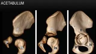 hip I