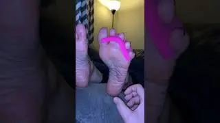 Toe Separator Removal 1/17/21