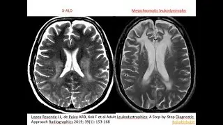 47. Leukodystrophy - introduction/overview; metabolic, genetic, MRI white matter patterns