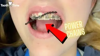 Braces Check Up - Changing wires and power chains - Tooth Time Family Dentistry New Braunfels Texas