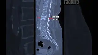 ✨Spine Burst Fracture✨ #radiology #education #neurology #anatomy #radiological #radiologytechnician
