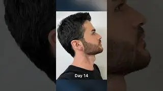 Beard Growth time lapse ⏳✨