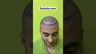 #sacekimi #sa&ccedil;əkimi #sacəkimi #sa&ccedil;ekimi #hairtransplantation #пересадкаволос