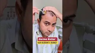 Derma Roller | Hair Regrowth | Micro needling process