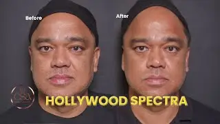 Anti aging and Anti pigmentation treatment using Hollywood Spectra