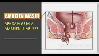 Cara Mengobati Sakit Ambeien Alami