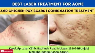 Best Laser Treatment for Acne and Chicken Pox Scars | Combination Treatment | Laser | Acne.