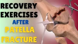Knee Physiotherapy: Recover from Patella fracture in 1 week