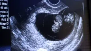Kenny & Ale's baby twins at 9 weeks 5 days 03.28.14