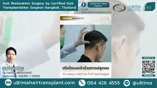Review of the results after 7 months of hair transplantation for men. || Dr.Ming, M.D., ABHRS