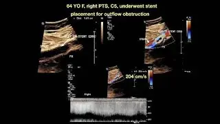 Missed Lesion After Stent Placement Duplex Findings  Velocity Ratio Explained