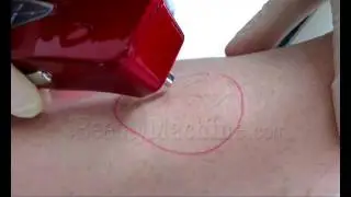 Mini laser 808 hair removal device, Epila 808 diode laser hair removal device