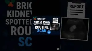 Bright kidney mass spotted during routine scan.
