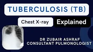 Chest Xray in Tuberculosis #cxr #TB #radiology