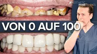 Totale Restauration im Ober- und Unterkiefer nach Z&auml;hneknirschen und Arbeitsunfall