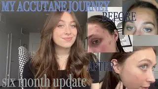 MY ACCUTANE JOURNEY: six month update