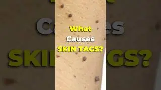 What Causes SKIN TAGS? #shorts