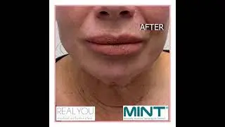 MINT PDO Thread - Instagram Clip - Real You Clinic