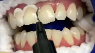 Процесс отбеливания Zoom 4