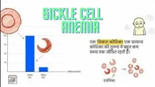 Sickle cell anemia|| सिकल सेल एनीमिया #sicklecell #anemia 
