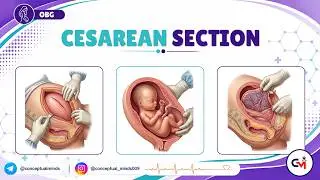 61.  Cesarean Section 🩺 OBG for USMLE Step 2 CK | Indications, Types & Complications