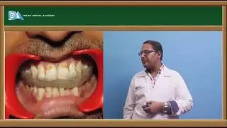 TEMPORARY ACRYLIC PARTIAL DENTURE | Prosthodontics | #DDS#MDS#BDS#NBDE#NEET