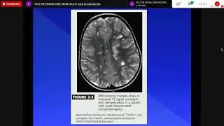 ENCEFALOMIELITIS DISEMINADA AGUDA (EMDA)