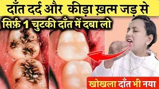 एक 1 चुटकी दाँत में दबा लो, दांत का कीड़ा और दर्द बाहर , खोखला दांत फिर से नया | Teeth Cavity