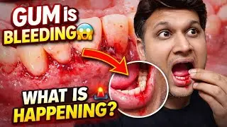 Bleeding Gums Problem || Causes & Treatment 