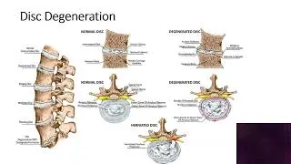 Low back pain Patient education