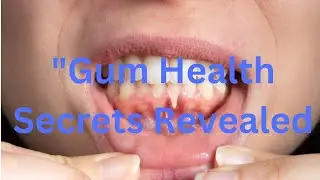 Heal Receding Gums Naturally 6 Superfoods Dentists Won't Tell You About!