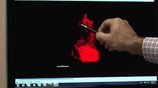 ALS motor neuron showing abnormal protein